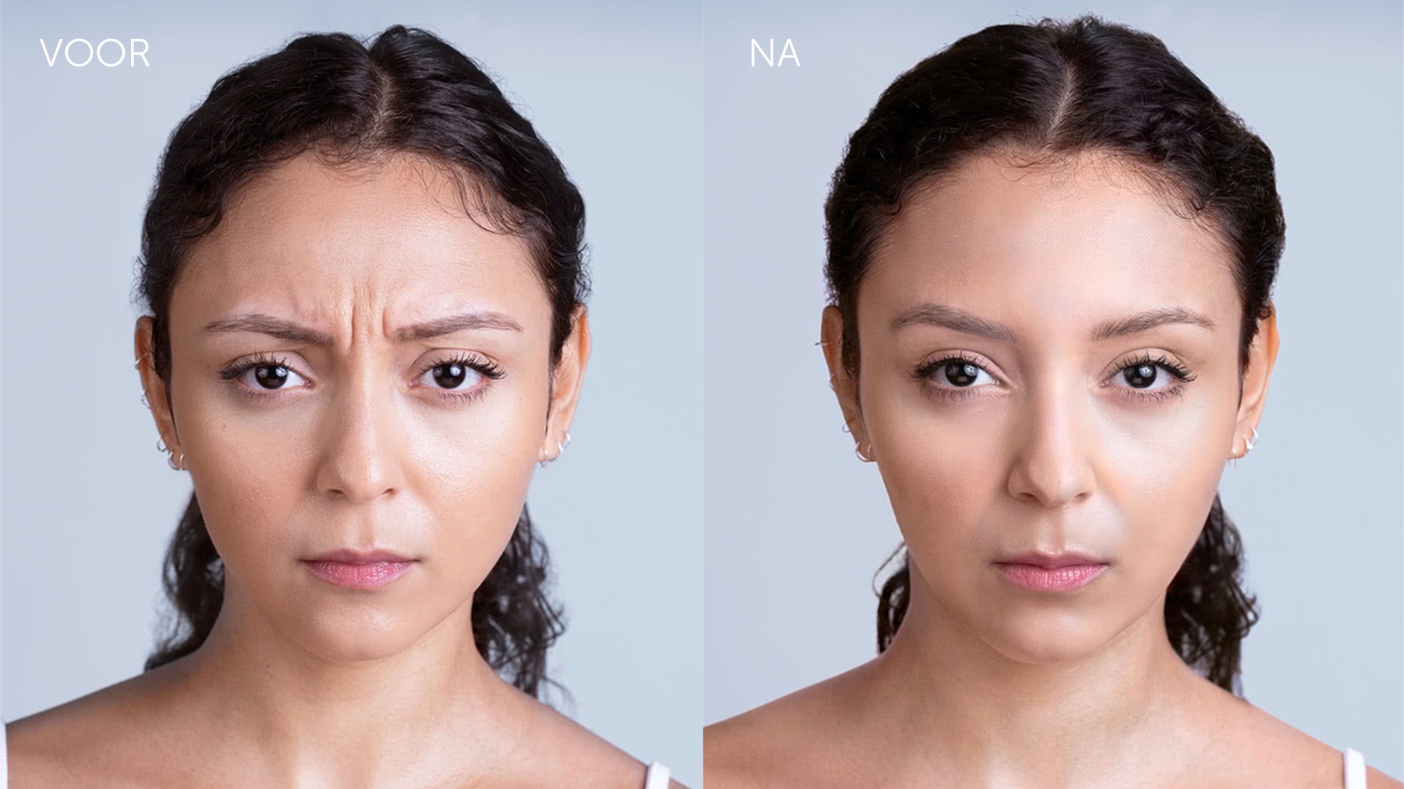 Botox behandeling in Amsterdam - Easy Cosmetics
